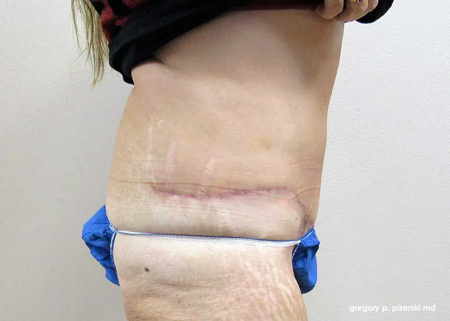 Tummy Tuck Before and After Pictures Lake Jackson, TX