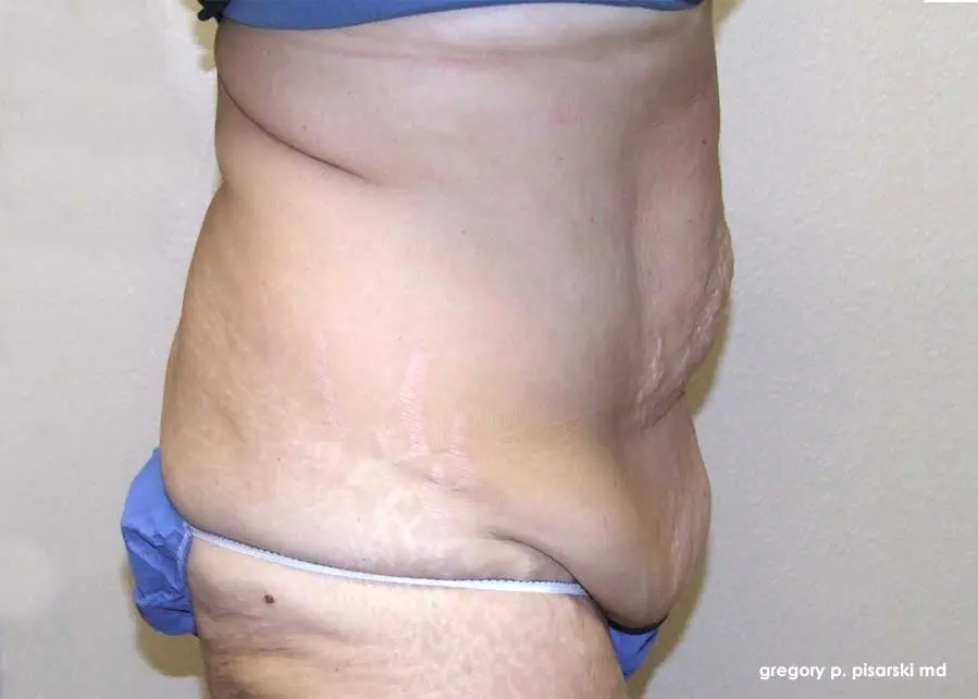 Tummy Tuck Before and After Pictures Lake Jackson, TX