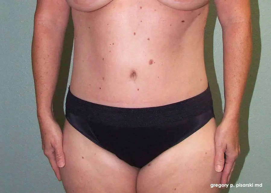Tummy Tuck Before and After Pictures Lake Jackson, TX