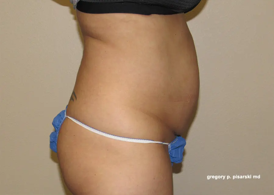 Tummy Tuck Before and After Pictures Lake Jackson, TX