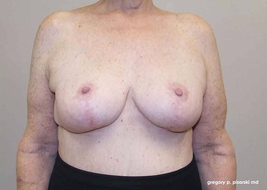 Breast Lift Before & After Pictures Lake Jackson, TX