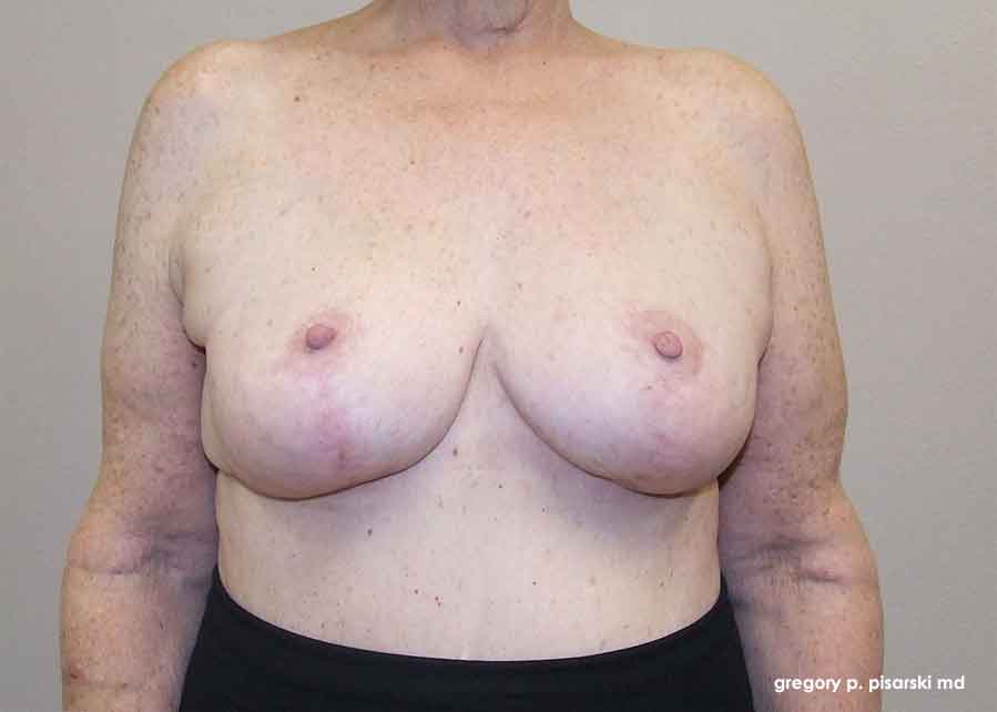 Before and After Picture Breast Lift Lake Jackson, TX