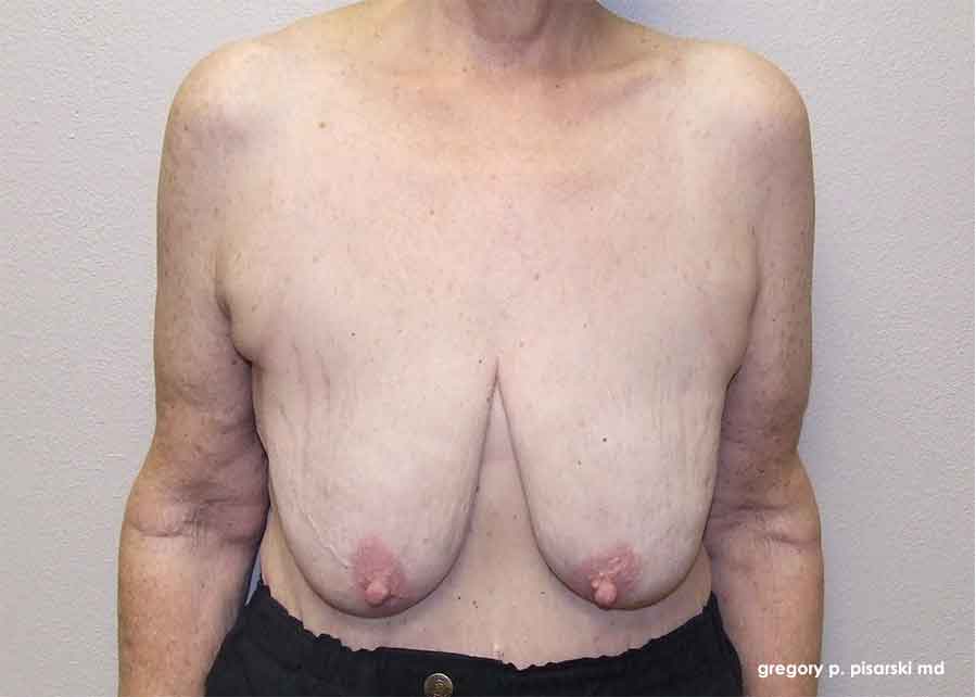 Before and After Picture Breast Lift Lake Jackson, TX