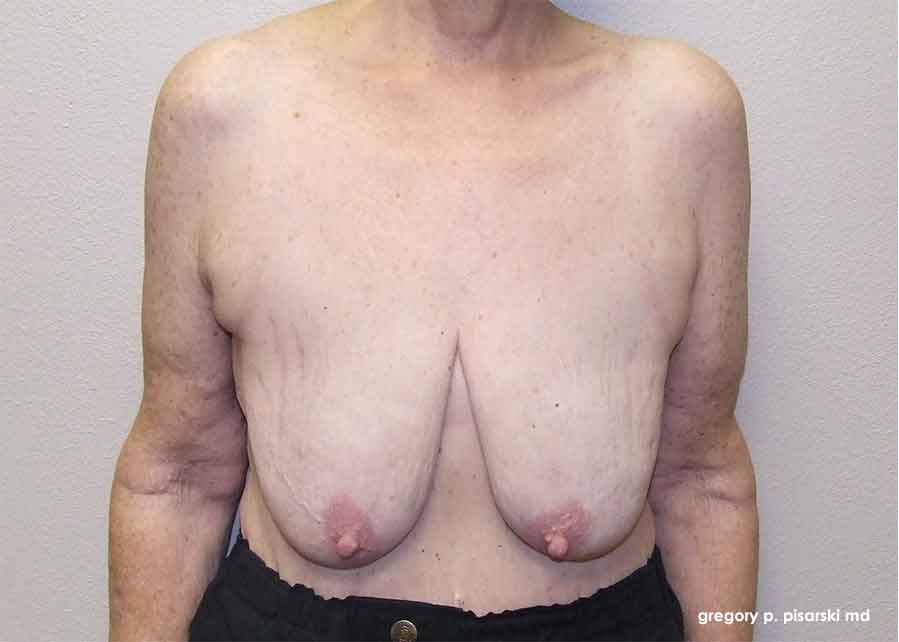 Breast Lift Before & After Pictures Lake Jackson, TX