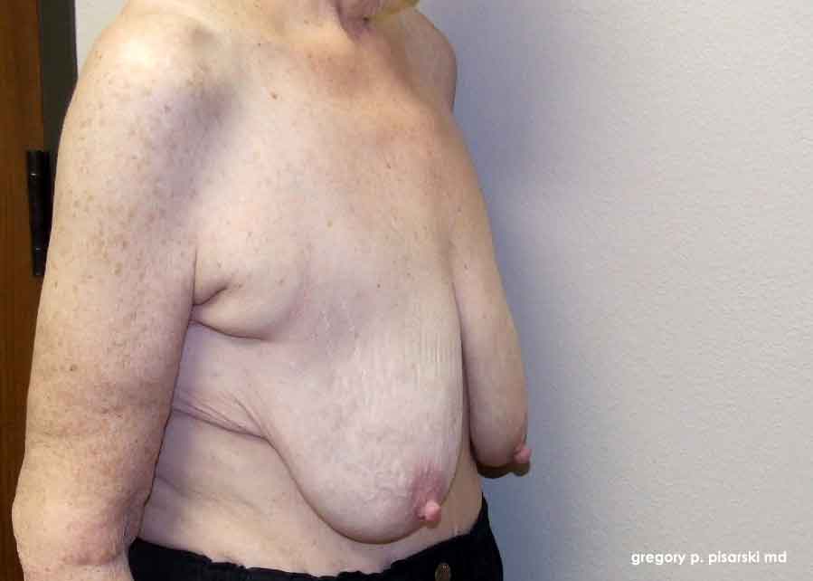 Breast Lift Before & After Pictures Lake Jackson, TX