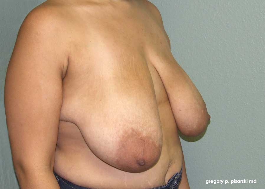 Breast Reduction Before and After Pictures Lake Jackson, TX
