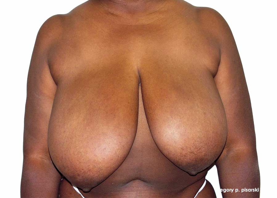 Breast Reduction Before and After Pictures Lake Jackson, TX