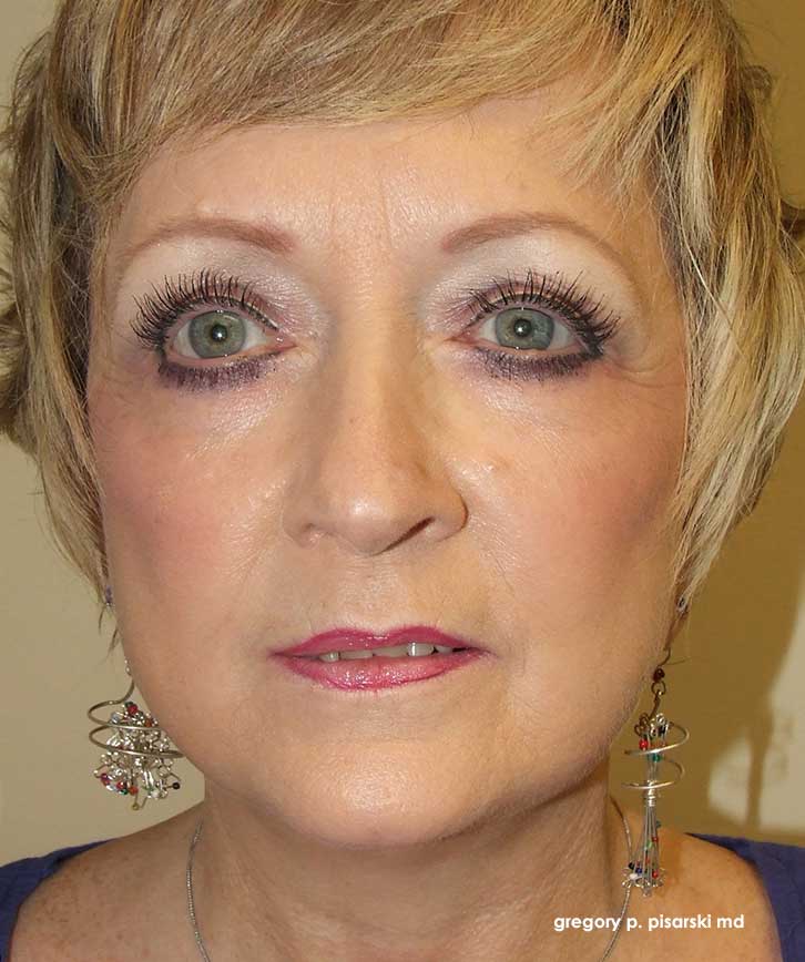 Before and After Blepharoplasty Lake Jackson, TX