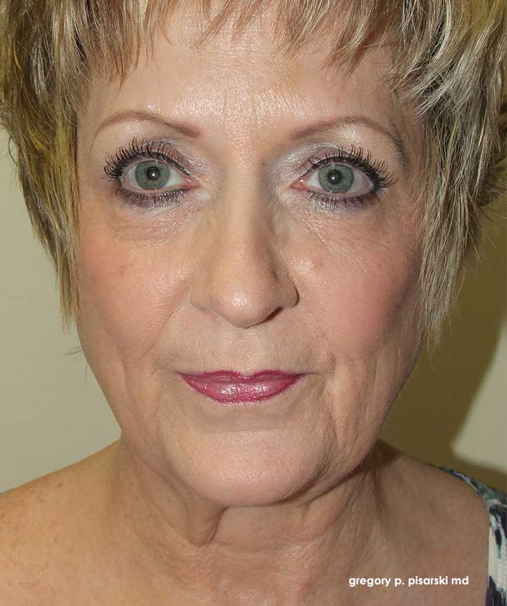 Before and After Blepharoplasty Lake Jackson, TX