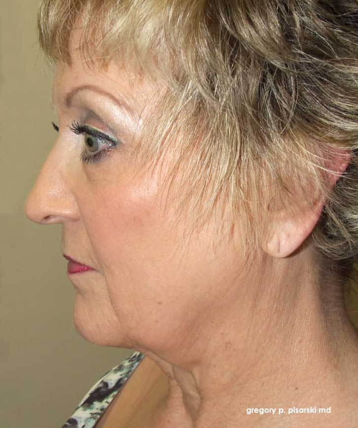 Blepharoplasty Before & After Pictures Lake Jackson, TX