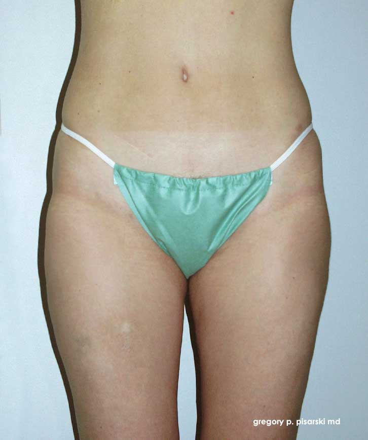 Liposuction Before and After Pictures Lake Jackson, TX