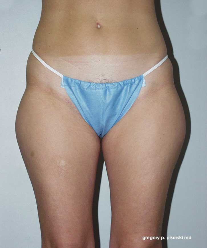 Liposuction Before and After Pictures Lake Jackson, TX