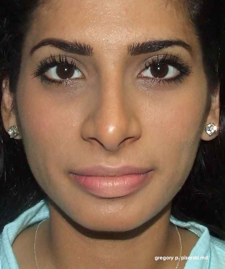 Before and After Picture Rhinoplasty Lake Jackson, TX