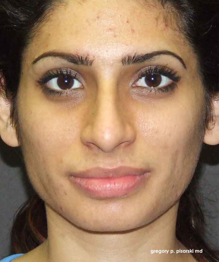 Before and After Picture Rhinoplasty Lake Jackson, TX