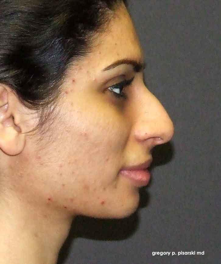 Before and After Picture Rhinoplasty Lake Jackson, TX