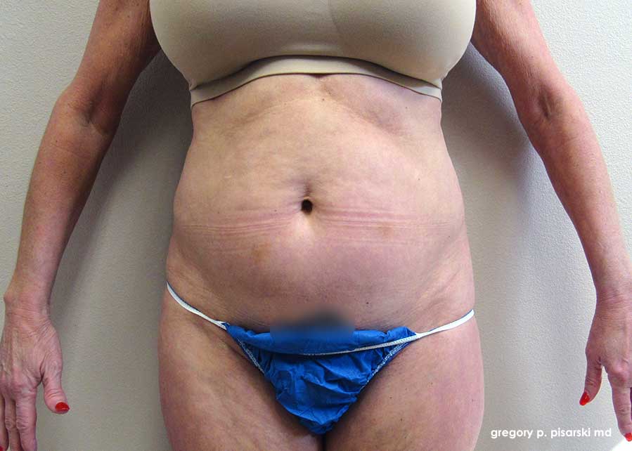 Smart Lipo Before and After Pictures Lake Jackson, TX