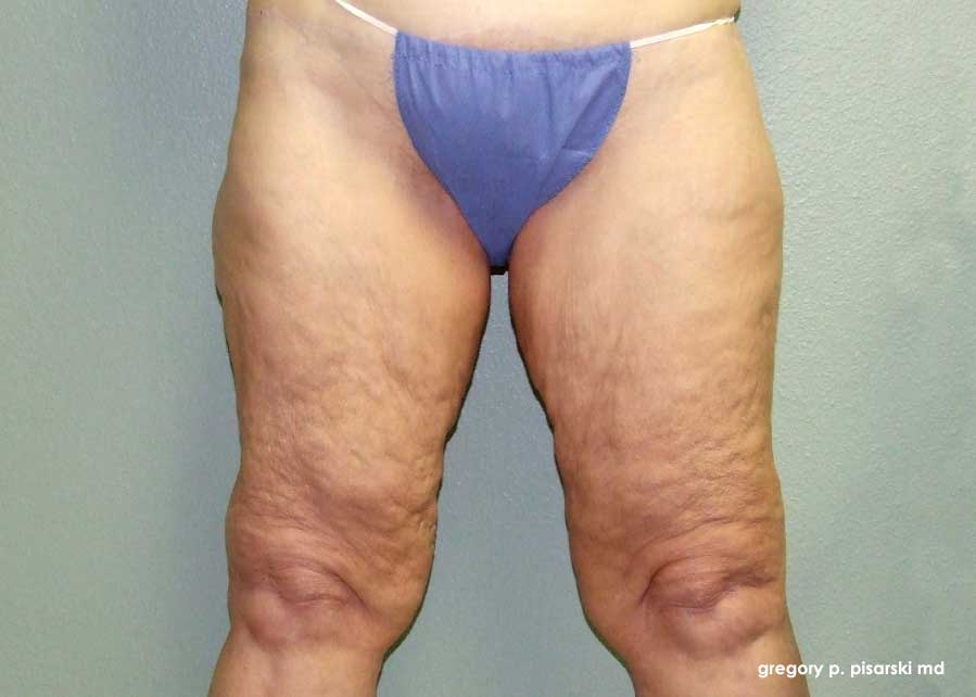 Thigh Lift Before and After Pictures Lake Jackson, TX