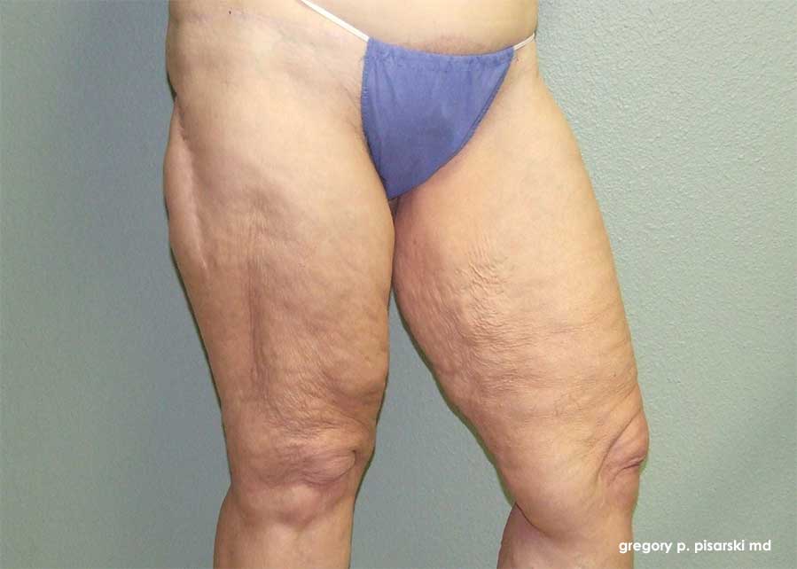 Thigh Lift Before and After Pictures Lake Jackson, TX