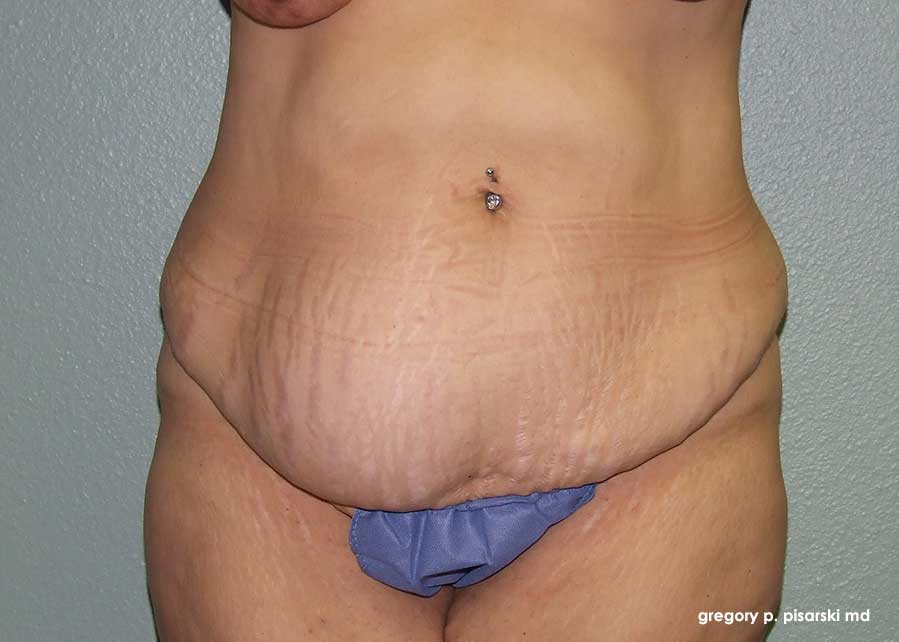 Tummy Tuck Before and After Pictures Lake Jackson, TX