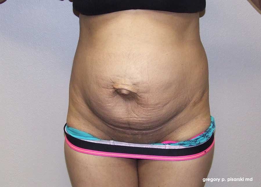 Tummy Tuck Before and After Pictures Lake Jackson, TX