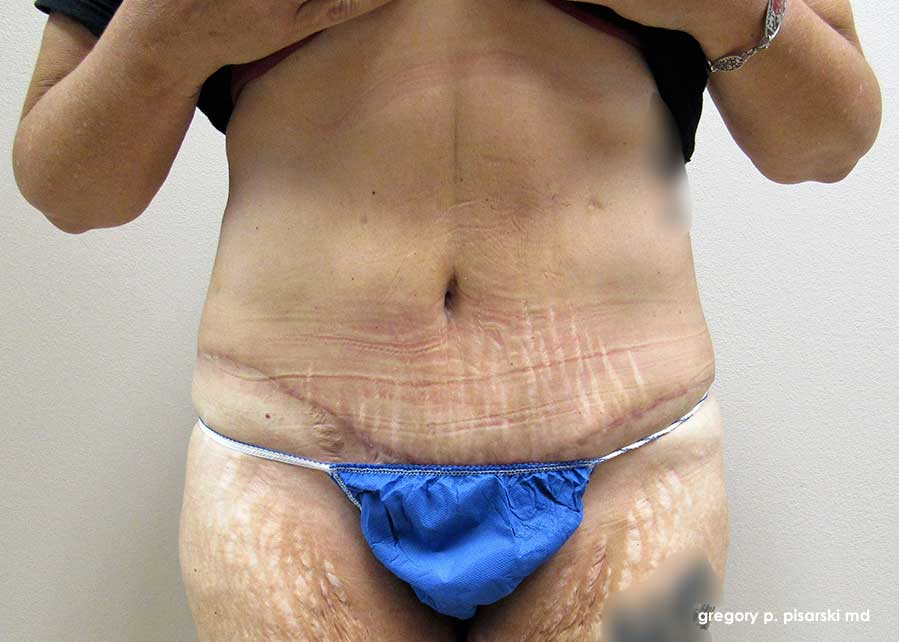 Tummy Tuck Before and After Pictures Lake Jackson, TX