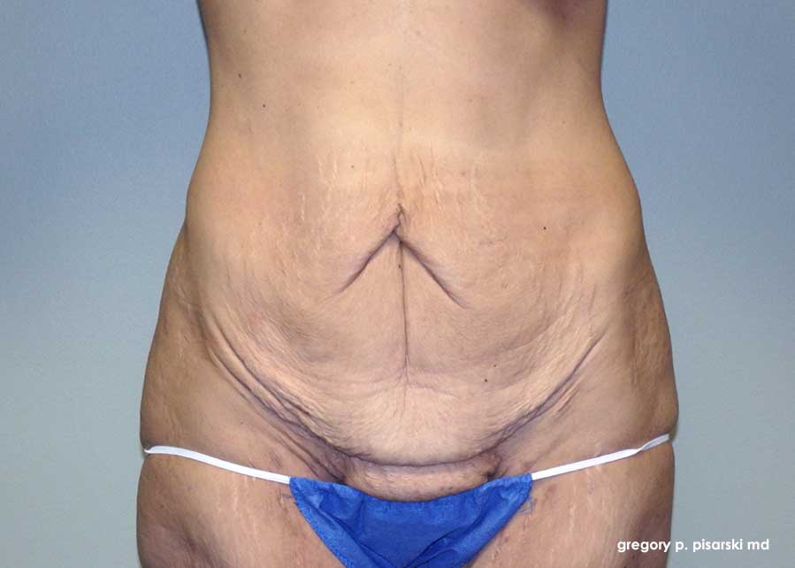 Tummy Tuck Before and After Pictures Lake Jackson, TX