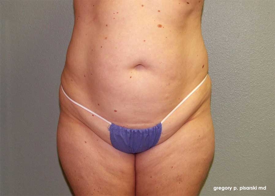 Tummy Tuck Before and After Pictures Lake Jackson, TX