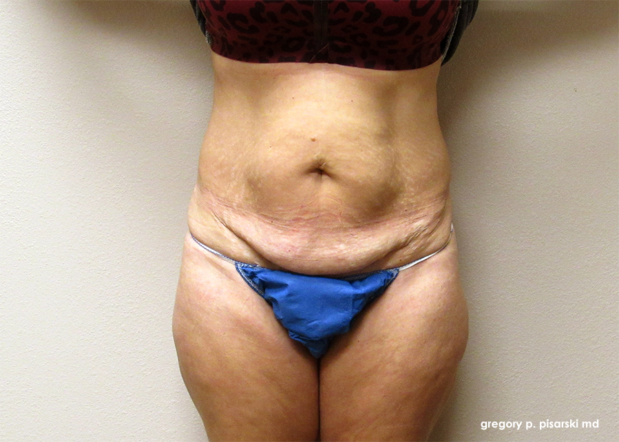 Tummy Tuck Before and After Pictures Lake Jackson, TX