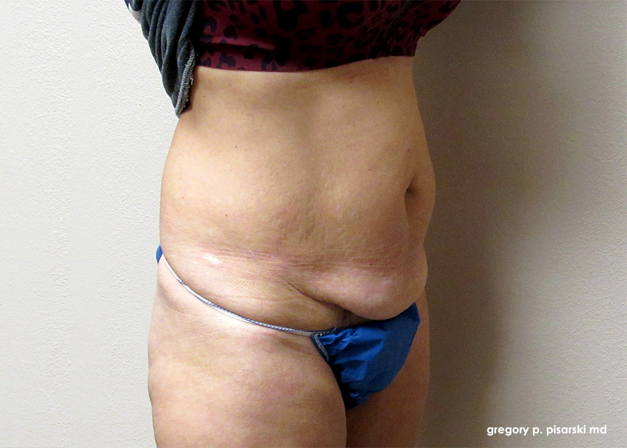 Tummy Tuck Before and After Pictures Lake Jackson, TX