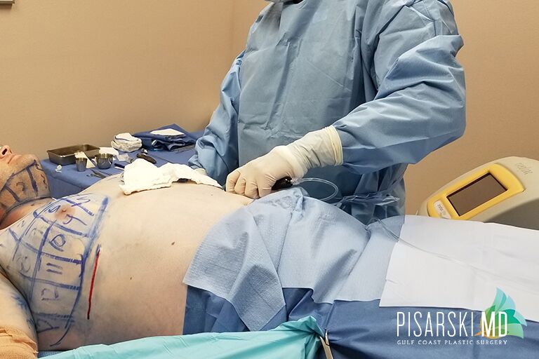 Smart Lipo and Gynecomastia Procedure