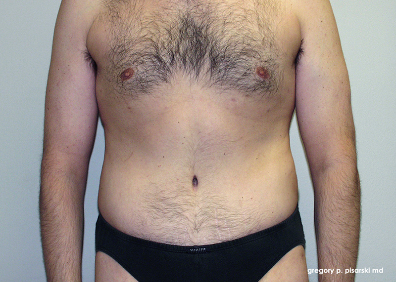 Male Abdominoplasty Before & After Pictures Lake Jackson, TX