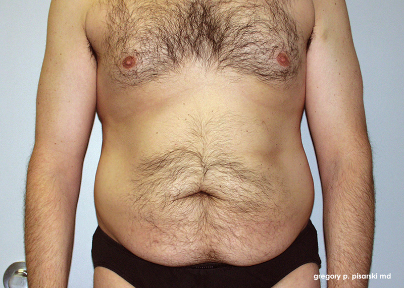 Male Abdominoplasty Before & After Pictures Lake Jackson, TX