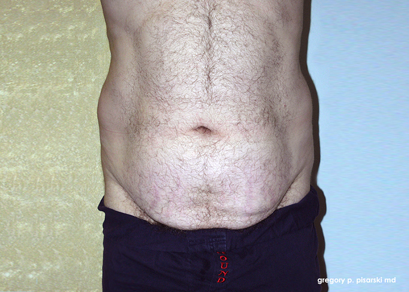 Before and After Male Abdominoplasty in Lake Jackson, TX