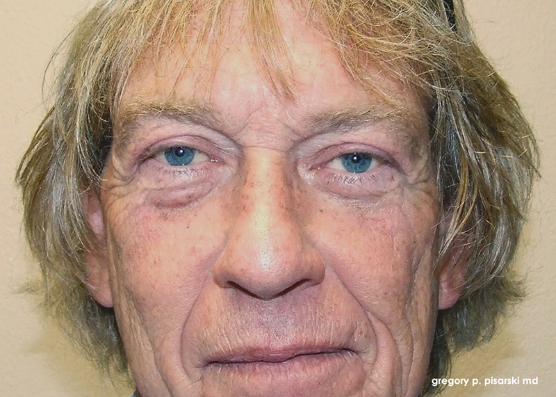 Before and After Male Blepharoplasty in Lake Jackson, TX