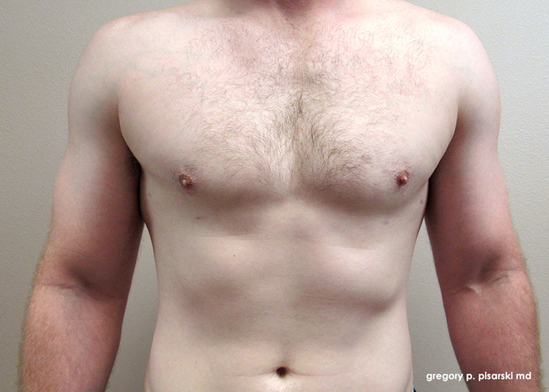 Male Gynecomastia Before and After Male Gynecomastia in Lake Jackson, TX