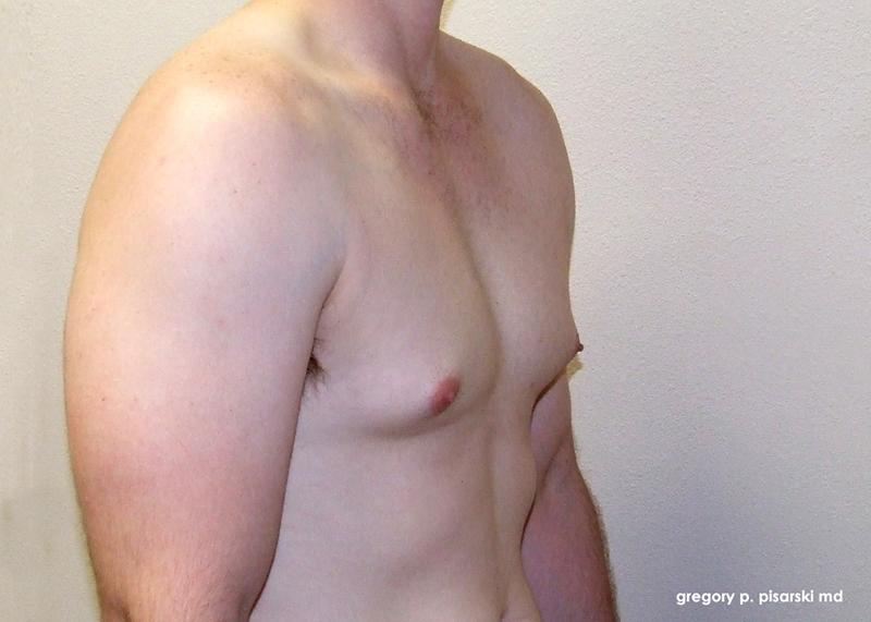 Male Gynecomastia Before and After Male Gynecomastia in Lake Jackson, TX