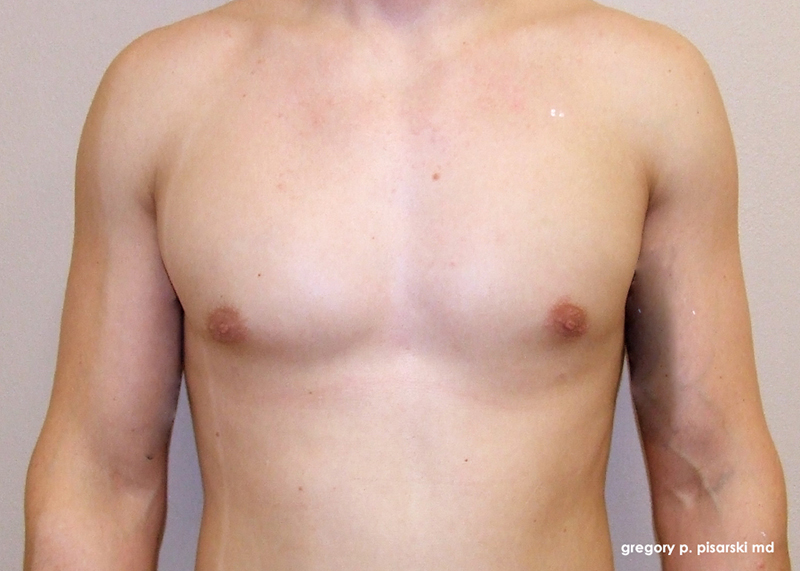Before and After Male Gynecomastia in Lake Jackson, TX