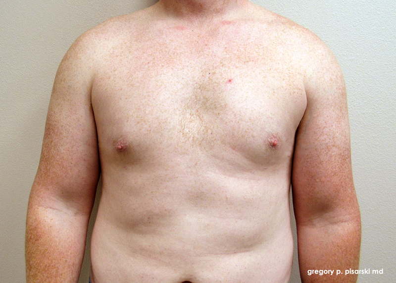 Male Gynecomastia Before and After Male Gynecomastia in Lake Jackson, TX