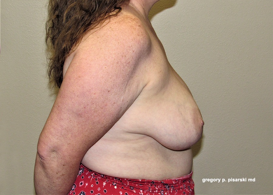 Breast Augmentation with Lift Before and After Pictures Lake Jackson, TX