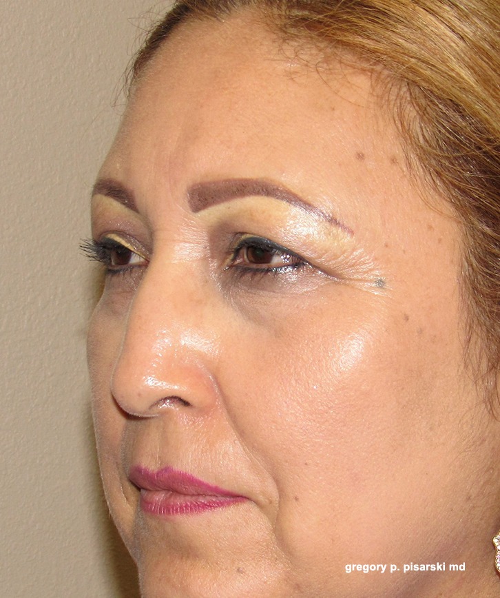 Brow Lift Before and After Pictures Lake Jackson, TX