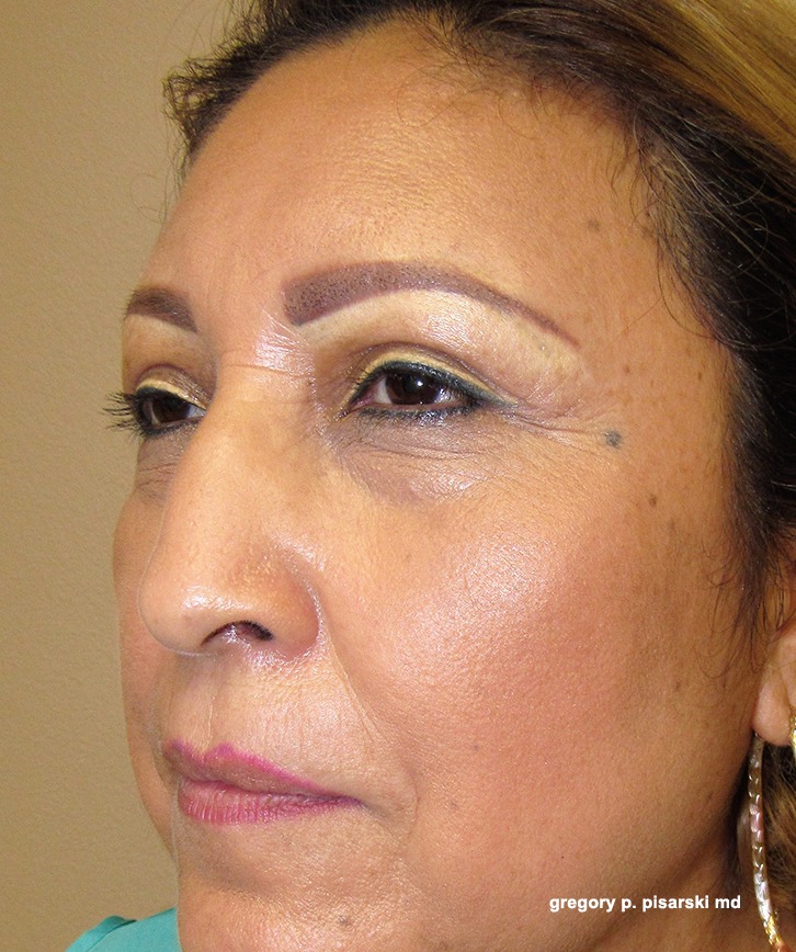 Brow Lift Before and After Pictures Lake Jackson, TX