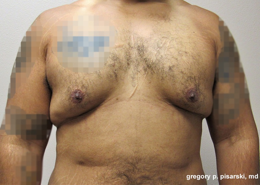 Male Gynecomastia Before and After Pictures Lake Jackson, TX