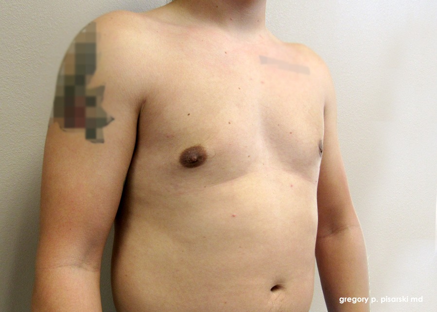 Male Gynecomastia Before and After Pictures Lake Jackson, TX