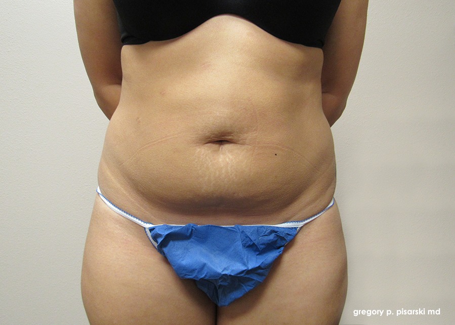 Smart Lipo Before and After Pictures Lake Jackson, TX
